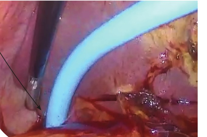 ACSIS sleeve in use during a minimally invasive procedure
